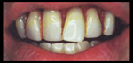 billy bob billybob buck teeth decay tooth dentist work braces cute